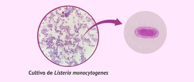 Imagen: Listeriosis