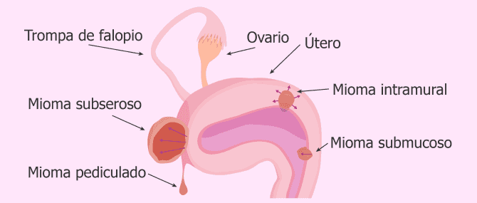 Imagen: Localización de los diferentes tipos de miomas