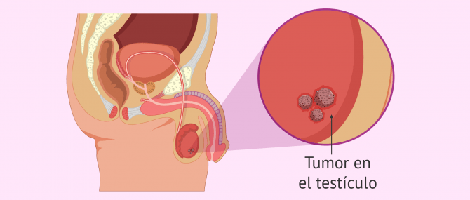 Imagen: Cáncer de testículo