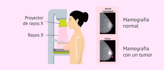 Imagen: ¿Qué es una mamografía?