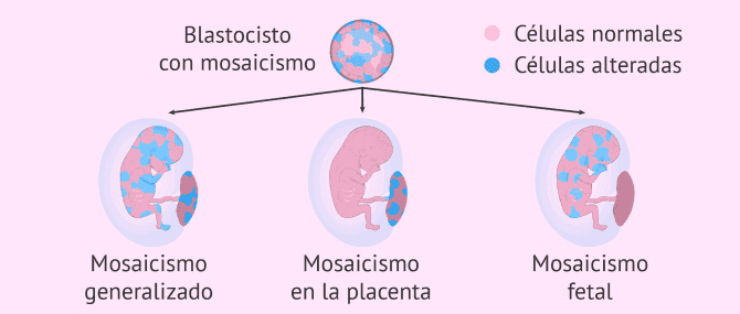 Imagen: Biopsia corial como control del embarazo