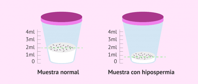 Imagen: Muestra seminal con hipospermia