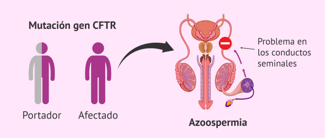 Imagen: Mutación del gen de la fibrosis quística