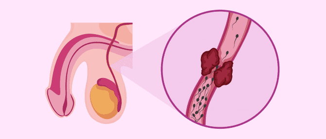 Imagen: Causas postesticulares de oligospermia