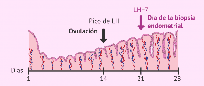 Imagen: Recolección del tejido endometrial