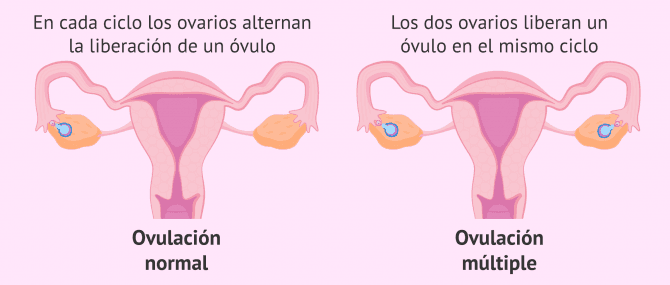 Imagen: Ovulación múltiple