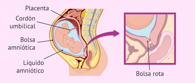 Imagen: Rotura de la bolsa o pérdida de líquido amniótico.