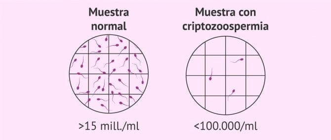 Imagen: Oligozoospermia severa