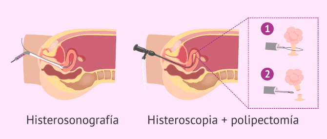 Imagen: Diagnóstico de los pólipos uterinos y polipectomía