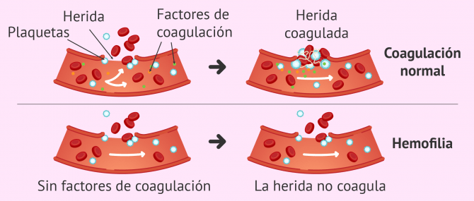 Imagen: Problemas de coagulación sanguínea por hemofilia