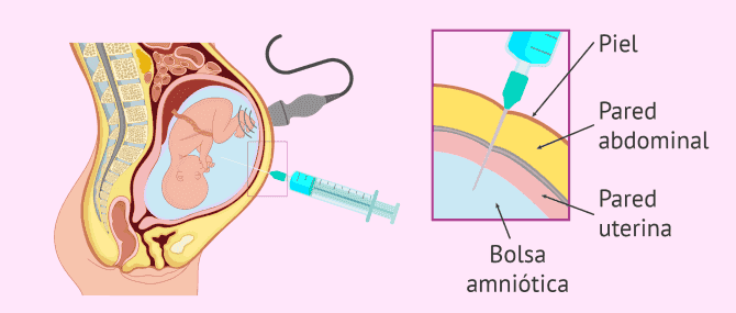 Imagen: Número de cromosomas y amniocentesis