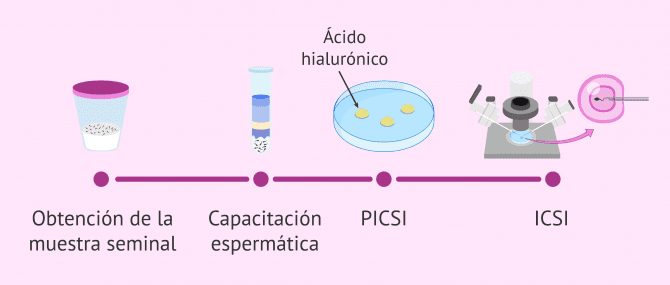 Imagen: Procedimiento ICSI