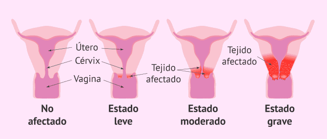 Imagen: Progresión del cáncer cervical