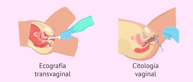 Imagen: Pruebas ginecológicas para evaluar la fertilidad femenina