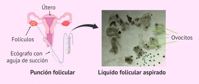 Imagen: Punción y obtención del líquido folicular