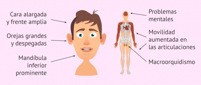 Imagen: Rasgos físicos en hombre con Síndrome de X Frágil