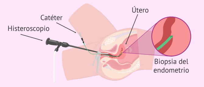 Imagen: Raspado endometrial