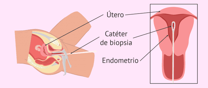 Imagen: Realización de biopsia endometrial