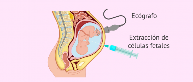 Imagen: Indicaciones de la aminiocentesis