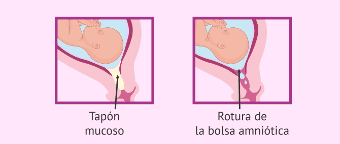 Imagen: Saco amniótico normal vs. roto