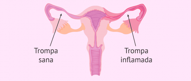 Imagen: Inflamación de las trompas (Salpingitis)