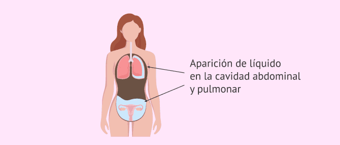 Imagen: Causas del Síndrome de Hiperestimulación Ovárica