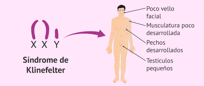 Imagen: Características del síndrome de Klinefelter