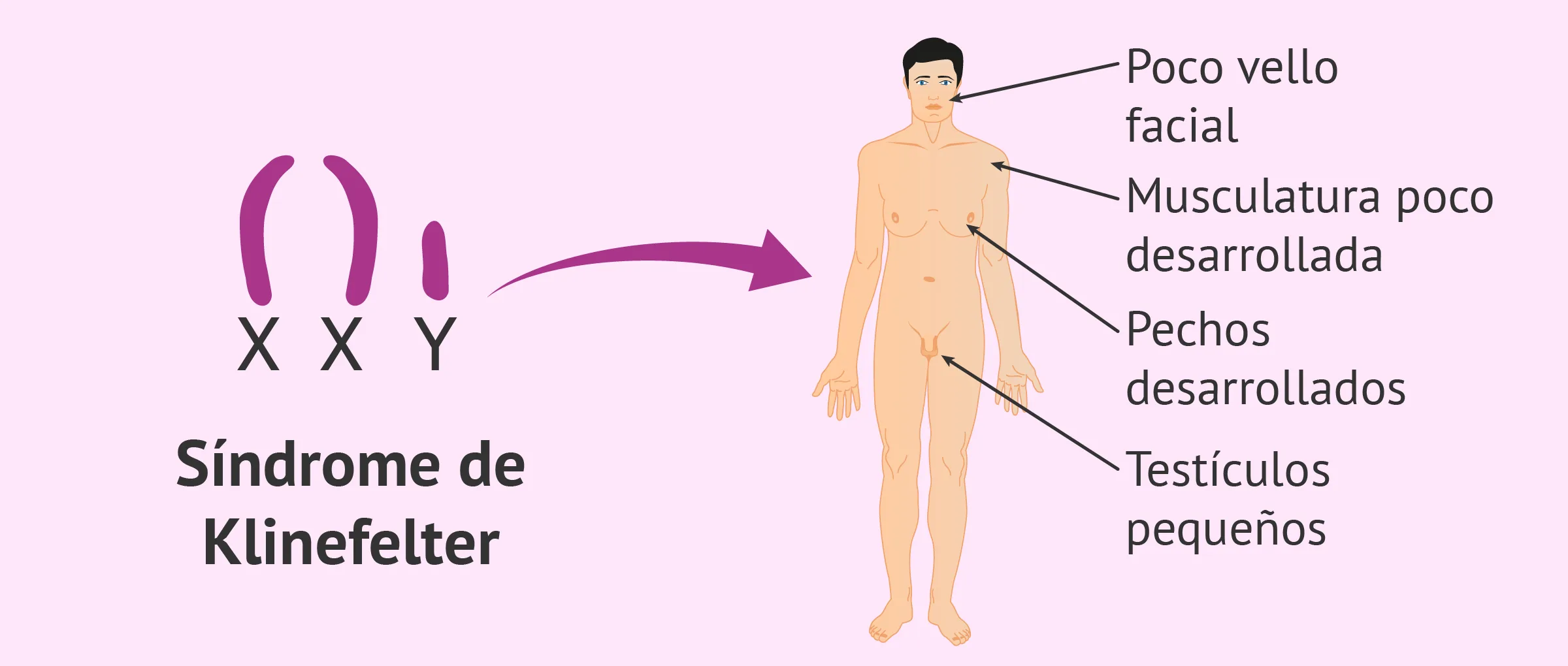 Características del síndrome de Klinefelter