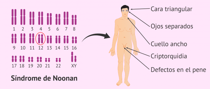 Imagen: Características del Síndrome de Noonan