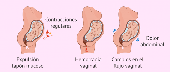 Imagen: Signos que delatan un parto prematuro