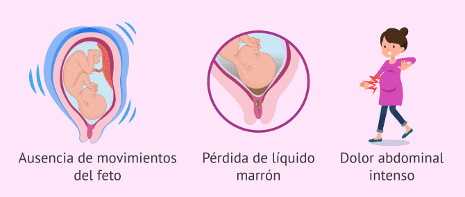 Imagen: Síntomas de la muerte fetal intrauterina