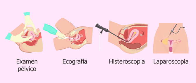 Imagen: Técnicas diagnósticas para miomas