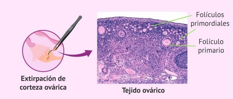 Imagen: Cáncer en el tejido ovárico