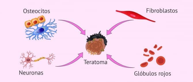 Imagen: Origen embrionario del teratoma