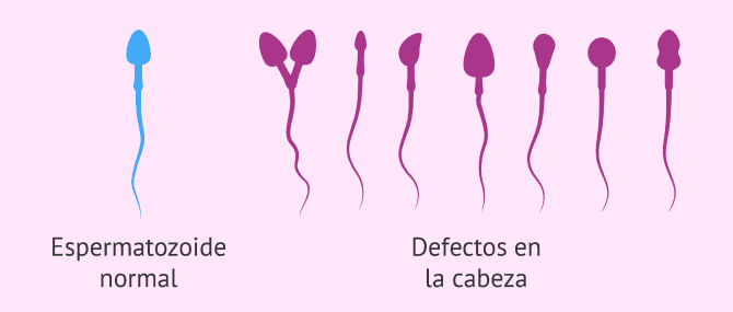 Imagen: Defectos en la cabeza de los espermatozoides