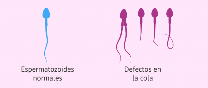 Imagen: Defectos en la cola de los espermatozoides