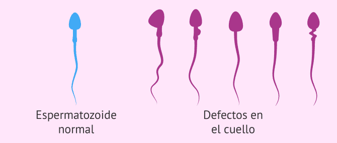 Imagen: Defectos en el cuello de los espermatozoides