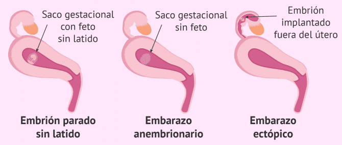 Imagen: Tipos de aborto según saco gestacional