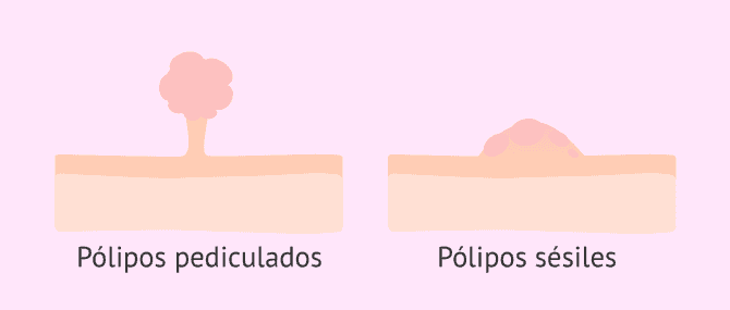 Imagen: Clasificación de los pólipos uterinos