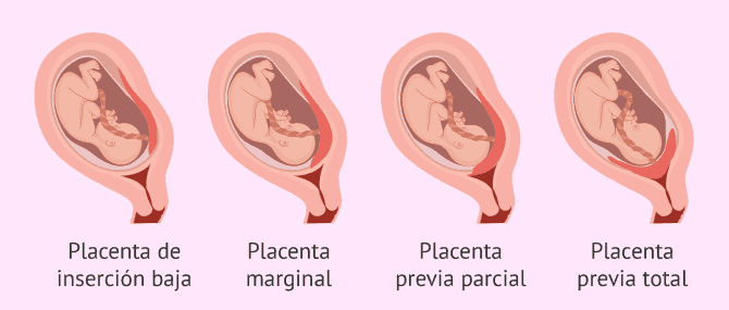 Imagen: Embarazo con placenta previa.