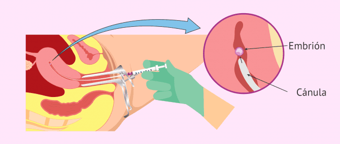 Imagen: Fase de transferencia embrionaria