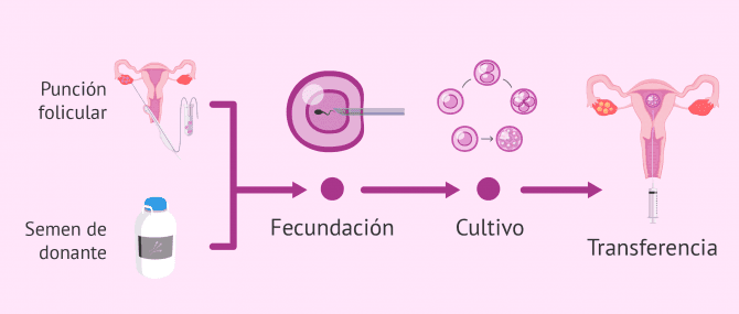 Imagen: Proceso FIV con semen de donante