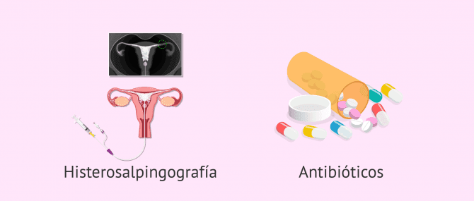 Imagen: Diagnóstico y tratamiento de la salpingitis