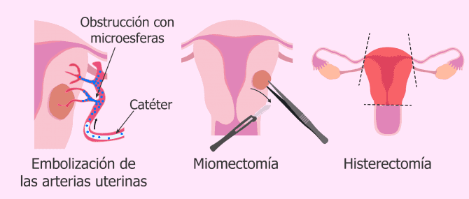 Imagen: Tratamientos invasivos para la miomatosis