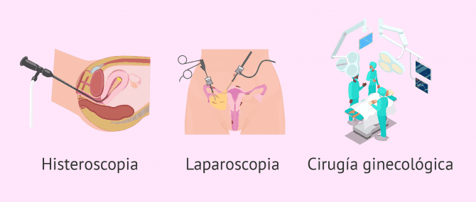 Imagen: Operaciones quirúrgicas en el útero