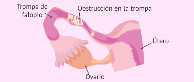 Imagen: Obstrucción de trompas