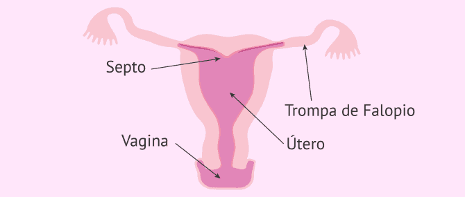 Imagen: Malformaciones uterinas