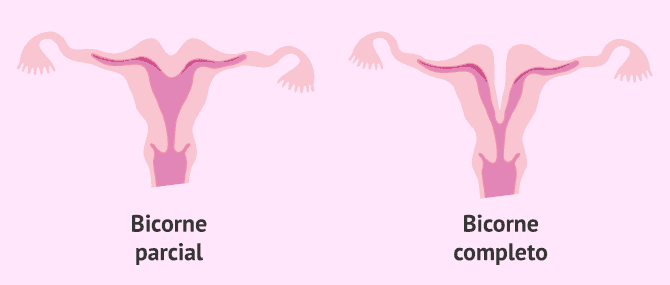 Imagen: Tipos de útero bicorne