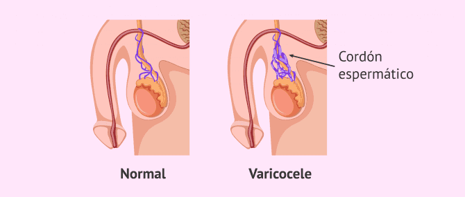 Imagen: Varicocele y azoospermia