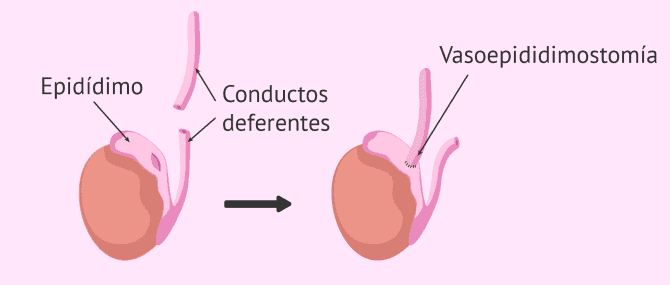 Imagen: Proceso de la vasoepididimostomía